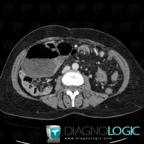 Cecal volvulus, Colon, CT