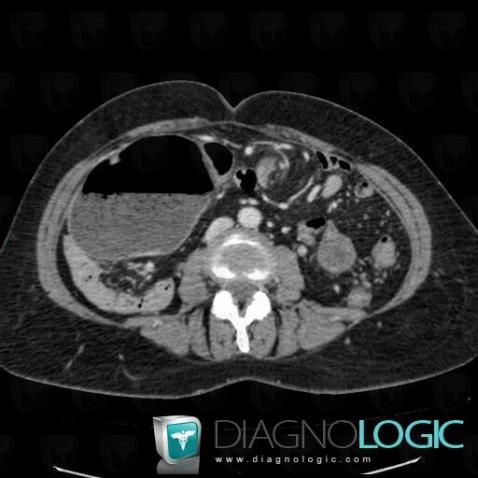 Cecal volvulus, Small bowel, CT