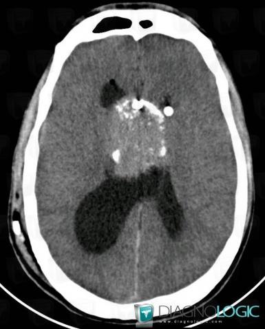 Central neurocytoma, Ventricles / Periventricular region, CT