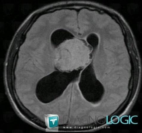 Central neurocytoma, Ventricles / Periventricular region, MRI