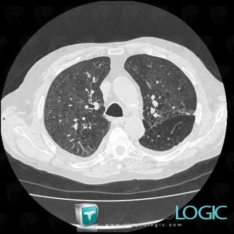 Centrilobular emphysema, Pulmonary parenchyma, CT