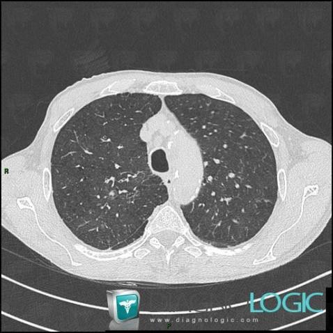 Centrilobular emphysema, Pulmonary parenchyma, CT