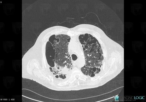 Centrilobular emphysema, Pulmonary parenchyma, CT