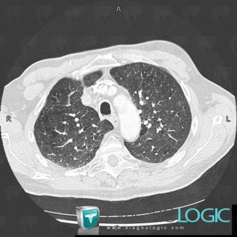 Centrilobular emphysema, Pulmonary parenchyma, CT