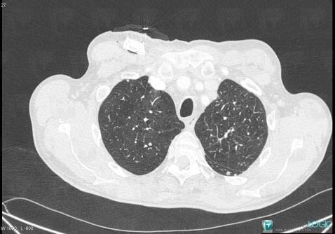 Centrilobular emphysema, Pulmonary parenchyma, CT