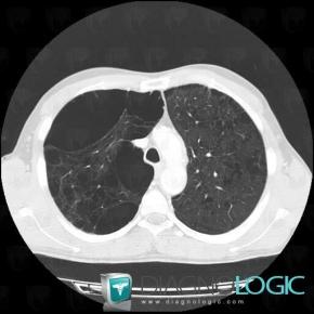 Centrilobular emphysema, Pulmonary parenchyma, CT