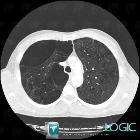 Centrilobular emphysema, Pulmonary parenchyma, CT