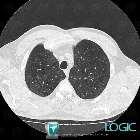 Centrilobular emphysema, Pulmonary parenchyma, CT