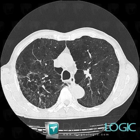 Centrilobular emphysema, Pulmonary parenchyma, CT