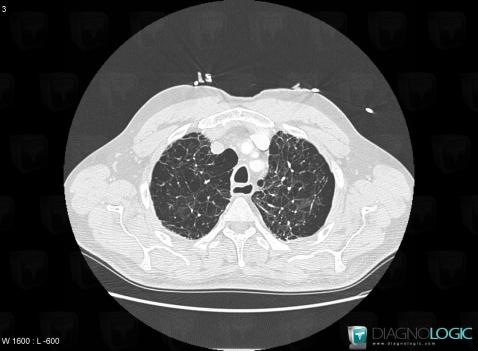 Centrilobular emphysema, Pulmonary parenchyma, CT