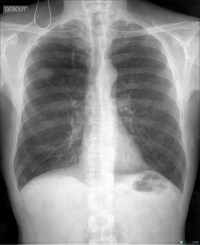 Centrilobular emphysema, Pulmonary parenchyma, X rays