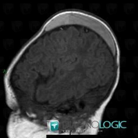 Cephalohematoma, Soft tissues - Skull, MRI