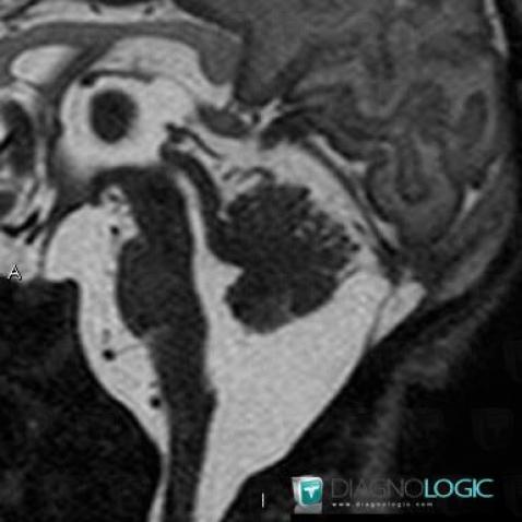 Cerebellar hypoplasia, Posterior fossa, MRI