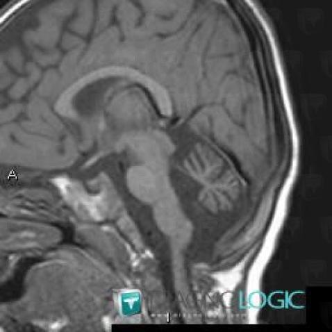 Cerebellar hypoplasia, Posterior fossa, MRI