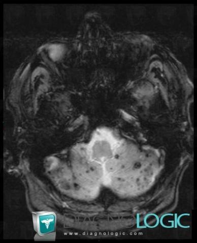 Cerebral amyloid angiopathy, Cerebellar hemisphere, Posterior fossa, MRI