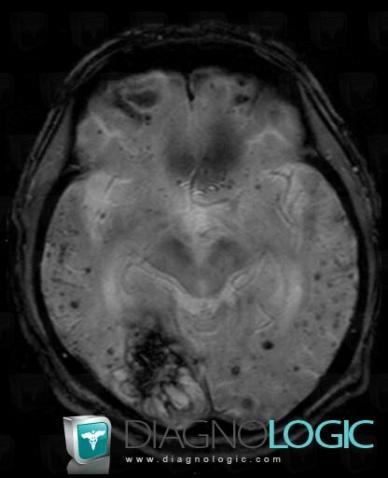 Cerebral amyloid angiopathy, Cerebral hemispheres, MRI