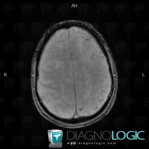 Cerebral amyloid angiopathy, Cerebral hemispheres, MRI