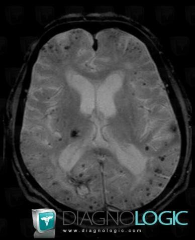 Cerebral amyloid angiopathy, Cortico subcortical region, Cerebral hemispheres, MRI