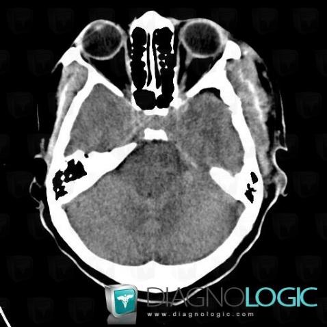 Cerebral edema, Posterior fossa, CT