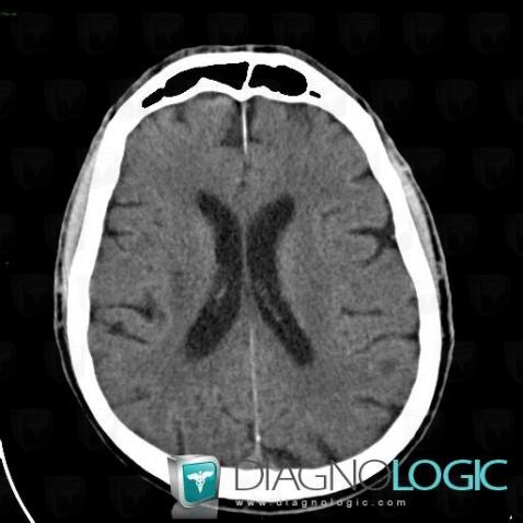 Cerebral infarction, Basal ganglia and capsule, CT