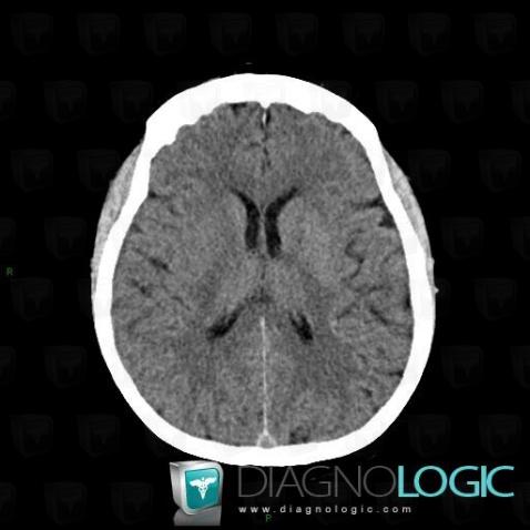 Cerebral infarction, Basal ganglia and capsule, CT