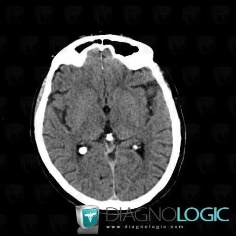 Cerebral infarction, Basal ganglia and capsule, CT