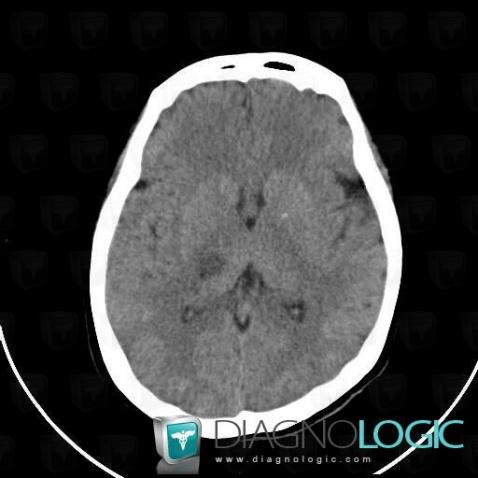 Cerebral infarction, Basal ganglia and capsule, CT