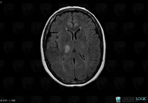 Cerebral infarction, Basal ganglia and capsule, MRI