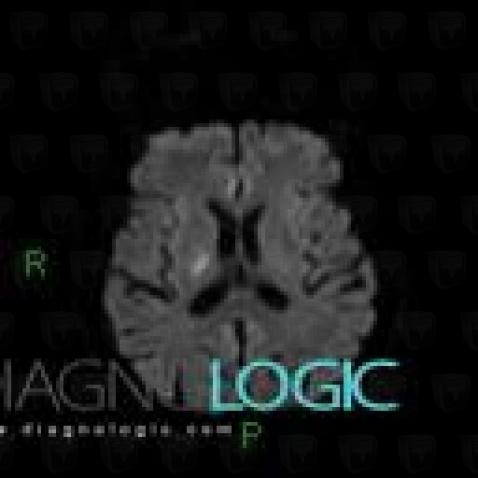 Cerebral infarction, Basal ganglia and capsule, MRI