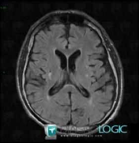 Cerebral infarction, Basal ganglia and capsule, MRI