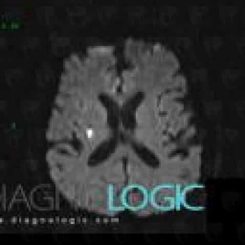 Cerebral infarction, Basal ganglia and capsule, MRI