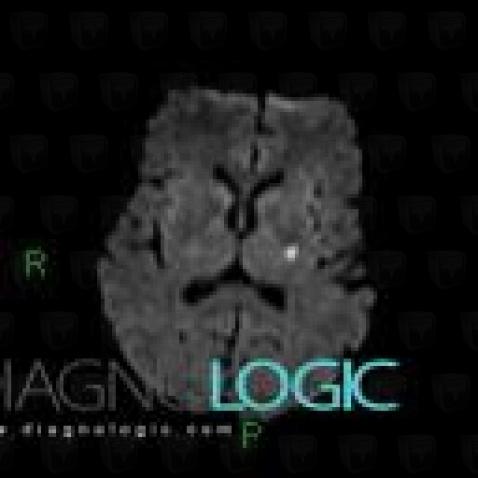 Cerebral infarction, Basal ganglia and capsule, MRI