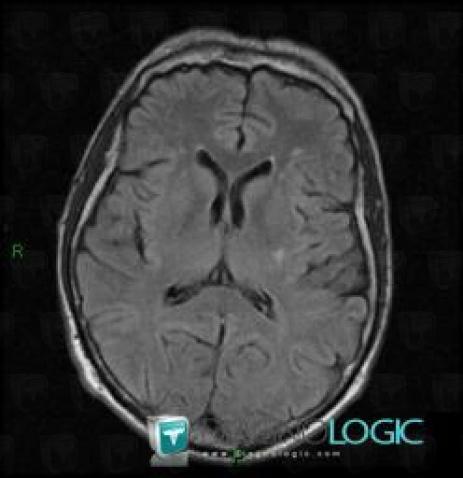 Radiology case : Cerebral infarction (MRI) - Diagnologic