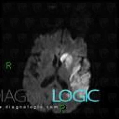 Cerebral infarction, Basal ganglia and capsule, MRI