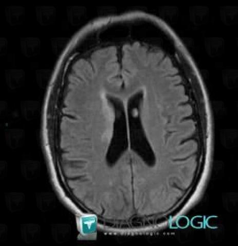 Cerebral infarction, Basal ganglia and capsule, MRI