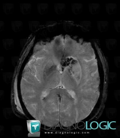 Cerebral infarction, Basal ganglia and capsule, MRI