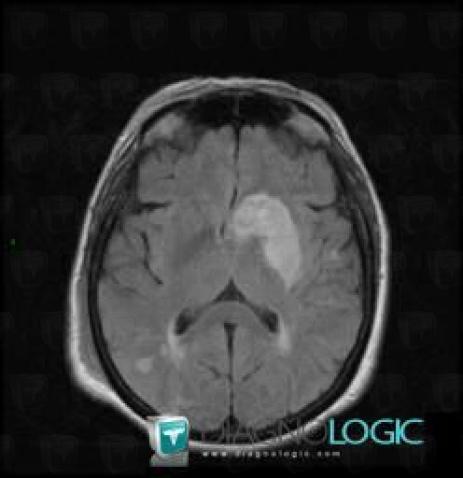 Cerebral infarction, Basal ganglia and capsule, MRI