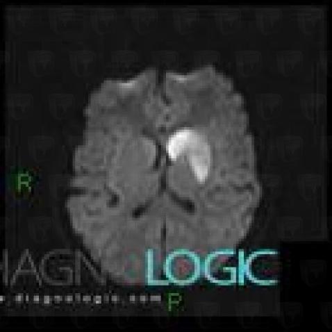 Radiology case : Cerebral infarction (MRI) - Diagnologic