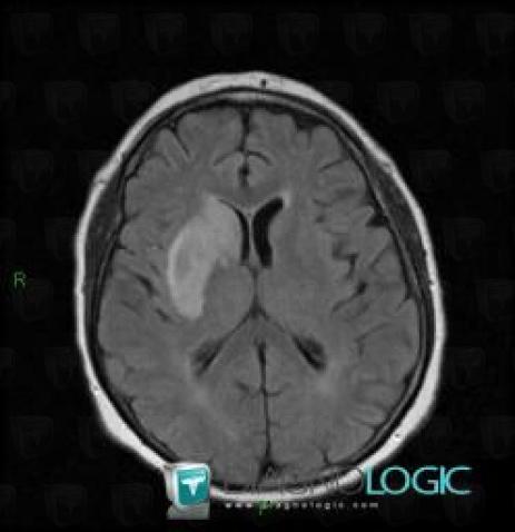 Cerebral infarction, Basal ganglia and capsule, MRI