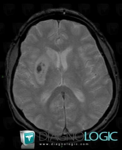Cerebral infarction, Basal ganglia and capsule, MRI