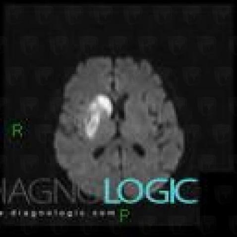 Radiology case : Cerebral infarction (CT ,MRI) - Diagnologic