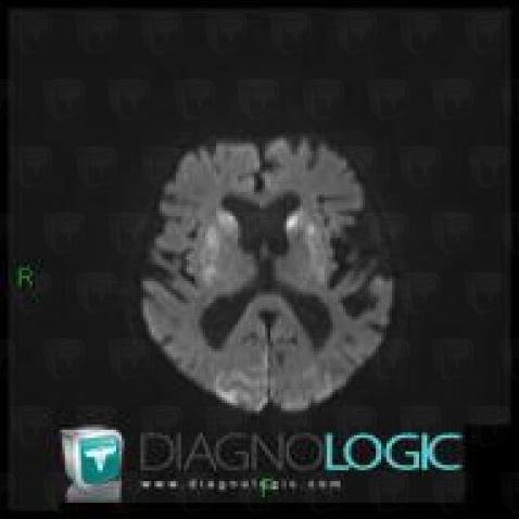 Cerebral infarction, Basal ganglia and capsule, MRI