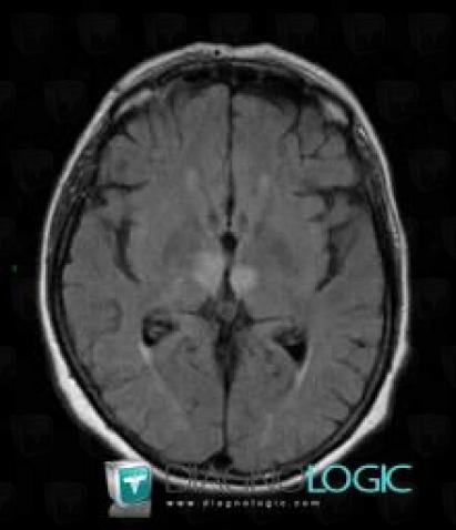 Cerebral infarction, Basal ganglia and capsule, MRI