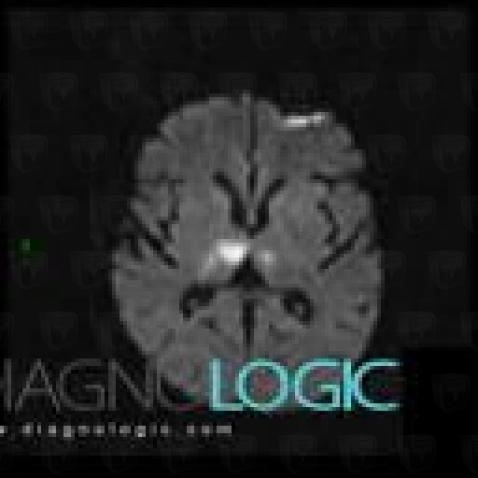 Cerebral infarction, Basal ganglia and capsule, MRI