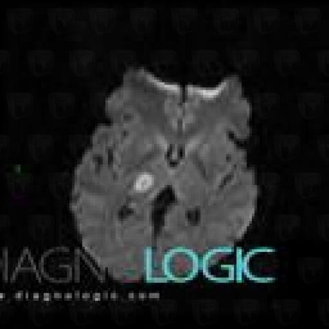 Cerebral infarction, Basal ganglia and capsule, MRI