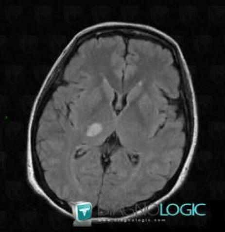 Cerebral infarction, Basal ganglia and capsule, MRI