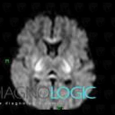 Cerebral infarction, Basal ganglia and capsule, MRI