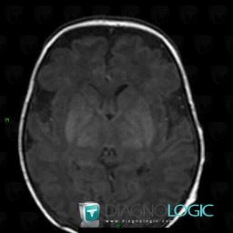 Cerebral infarction, Basal ganglia and capsule, MRI