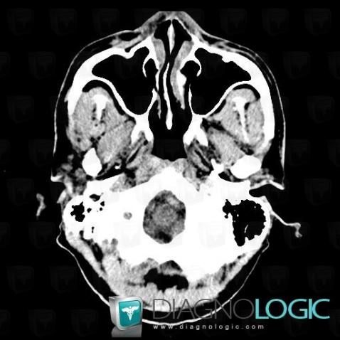 Cerebral infarction, Brainstem, CT