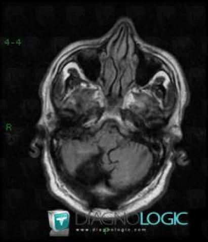 Cerebral infarction, Brainstem, MRI